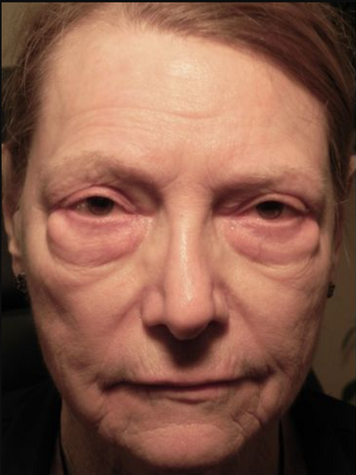 Before using Face Tightening + Eyebag Removal Cream