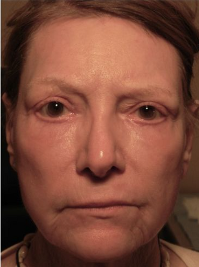 After using Face Tightening + Eyebag Removal Cream