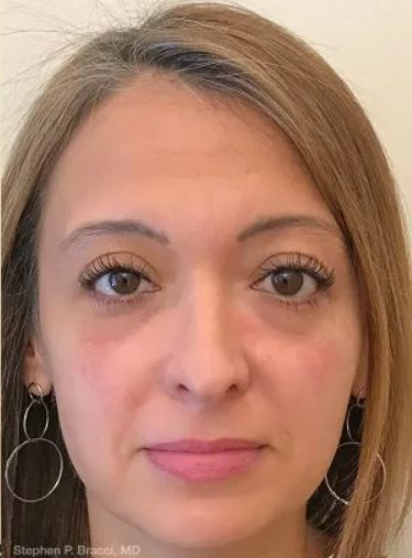 After using Face Tightening + Eyebag Removal Cream