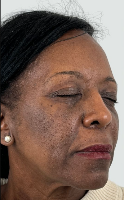 Before using Face Tightening + Eyebag Removal Cream