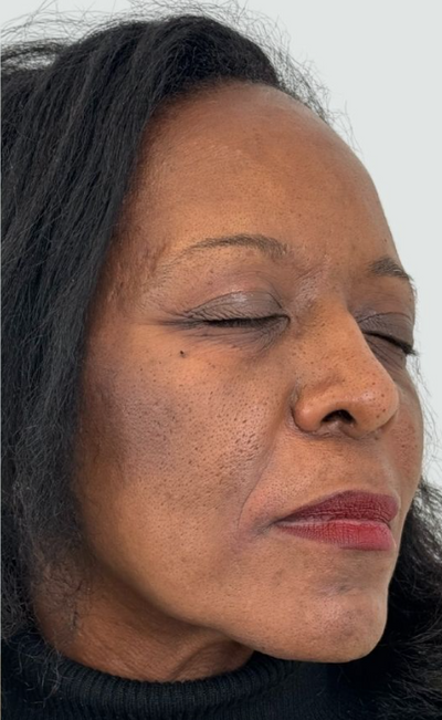 After using Face Tightening + Eyebag Removal Cream