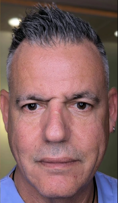 After using Face Tightening + Eyebag Removal Cream