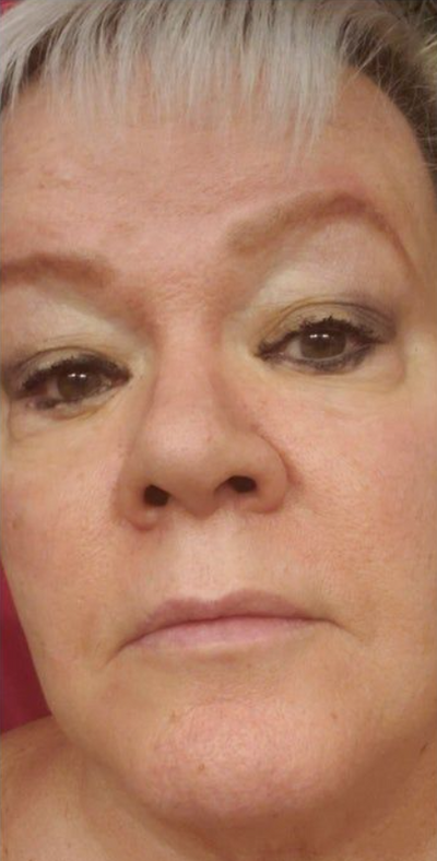 After using Face Tightening + Eyebag Removal Cream