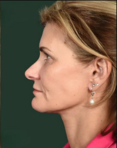 After using UV Neck & Face Massager