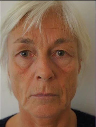 Before using UV Neck & Face Massager