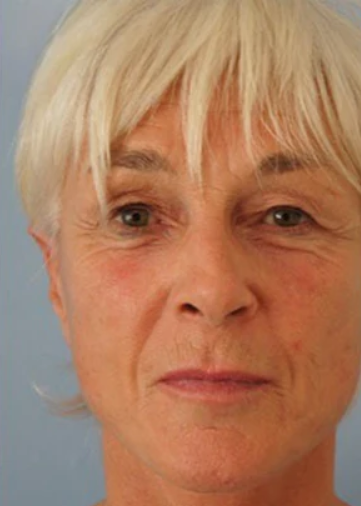 After using UV Neck & Face Massager