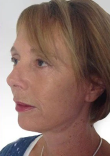 After using UV Neck & Face Massager